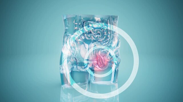 Conceptual 3D animation of a human hernia