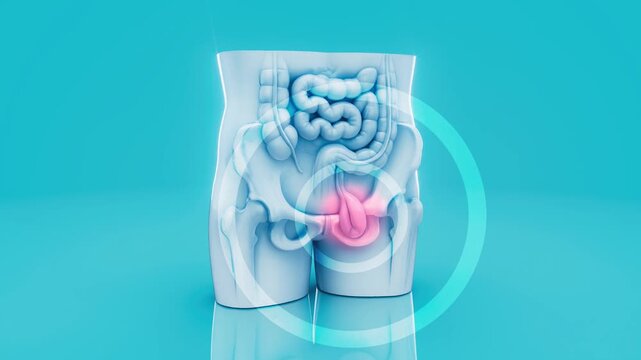 Conceptual 3D animation of a human hernia