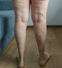 close-up of lower legs showing prominent varicose veins standing on wooden floor near blue sofa in bright indoor home setting ideal for medical marketing, healthcare education