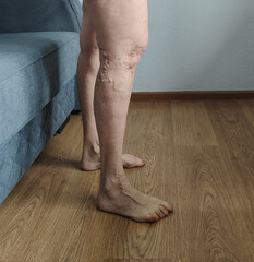  side view of legs showing prominent varicose veins standing on wooden floor near sofa in indoor home environment ideal for medical marketing, healthcare education, vein treatment promotions