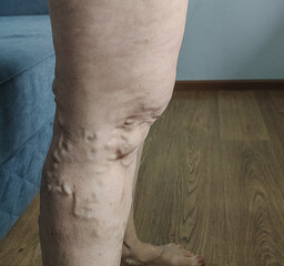  close-up of lower leg showing prominent varicose veins standing on wooden floor beside blue sofa in bright indoor home environment ideal for medical marketing, healthcare education, vein treatment 