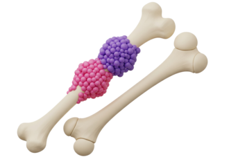Bone Tumor / Cancer Concept: 3D Medical Illustration of Abnormal Growths on a Human Skeleton, Representing Osteosarcoma, Bone Disease & Conditions.