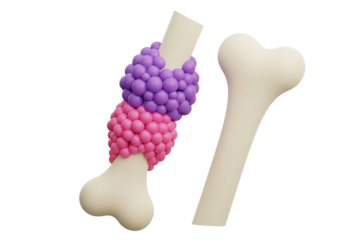 Bone Disease & Abnormal Cell Growth: 3D Medical Concept of Bone Marrow Condition, Tumor, or Cancer