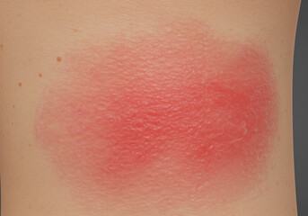 Fototapeta premium Close-up view of a red, inflamed skin reaction, possibly a bite or allergic response, showing a swollen, irritated area on human skin.