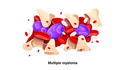 Bone marrow cells red purple white bone fragments blood