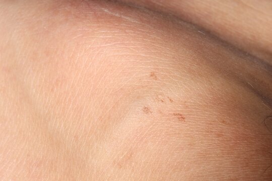 Macro view of human skin with birthmarks as background