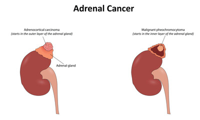 Adrenal cancer vector illustration