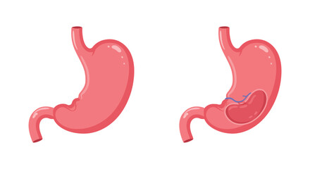Healthy Stomach and Stomach with Ulcer Medical Illustration of Digestive System