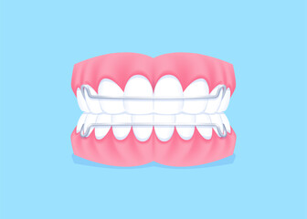 Full mouth teeth - Hawley retainer illustration vector design. Dental care concept.