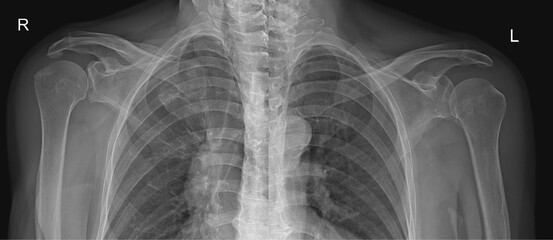 Left and Right Shoulder Joint AP Views 