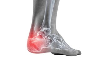 Realistic underside of human foot showing pain sore heel medical anatomy injury healthcare illustration element isolated on white background