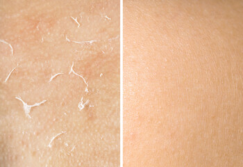 Fototapeta premium Dry skin on one side and moisturized on another, collage before and after