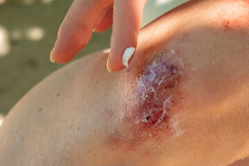 Fototapeta premium Injury on skin showing healing wound on elbow in sunny outdoor setting during summer afternoon