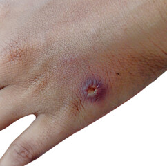 Wounded Hand with Bruising and Healing Signs Visible