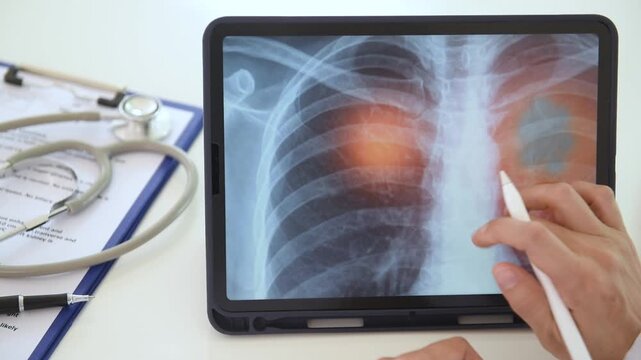 Pulmonologist doctor diagnose lung cancer or pneumonitis, tuberculosis by medical x-ray of lung scan at Chest and Respiratory Medical Center.