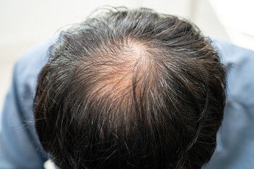 Bald in the middle head and begin no loss hair glabrous of mature Asian business smart active office man.
