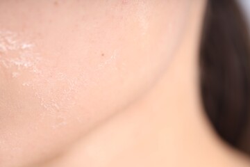 Fototapeta premium Woman with dry skin on her face, closeup