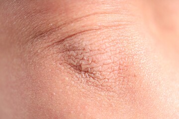Fototapeta premium Texture of dry skin as background, closeup
