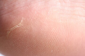 Woman with dry skin on her foot, closeup