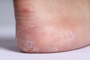 Woman with dry skin on her foot against light background, closeup
