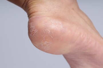 Woman with dry skin on her foot against light background, closeup