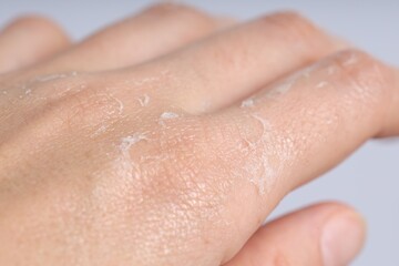 Fototapeta premium Woman with dry skin on her hand against light background, closeup