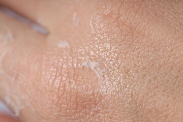 Woman with dry skin on her hand, closeup