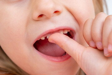 Little girl wiggling loose baby tooth with finger, Child focused on wobbly tooth, exploring changes...