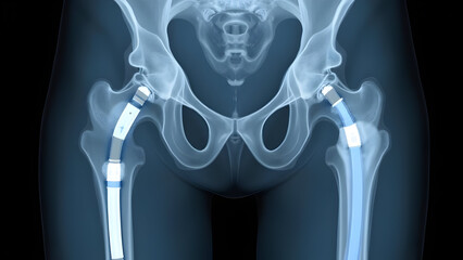 Augmentation Components for Complex Hip Revision Surgery