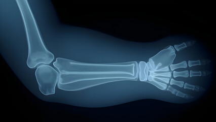 Olecranon Fracture Elbow Bony Prominence Triceps Muscle Disruption