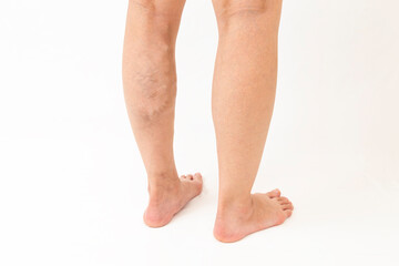 静脈瘤を患った女性の脚