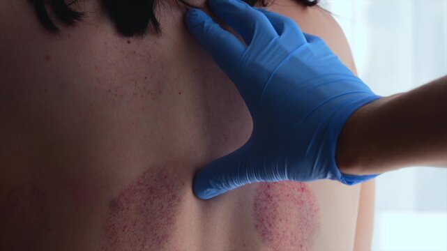 A girl after a cupping massage on her back.
Bruises on her body after a vacuum massage.
Bruising on the skin after a cupping massage.
Massage, health, medicine, treatment, scoliosis