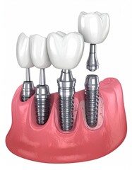 Dental implants bridge, screws, and crown detail