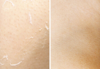 Dry skin on one side and moisturized on another, collage before and after