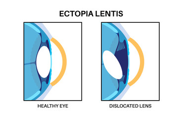 Ectopia lentis disease