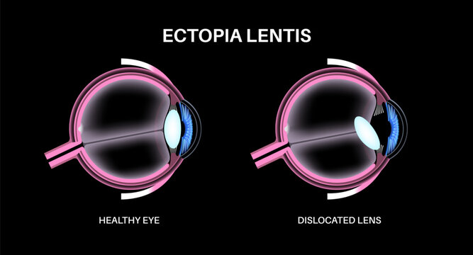 Ectopia lentis disease