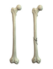 Femur bone with shaft fracture, 3D illustration