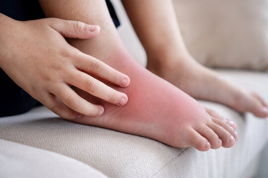 Asian boy scratching his feet with redness and itching caused by an insect bite. Close-up view of a child&rsquo;s leg showing skin rash, red spots, and allergic reaction to insect.