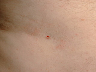 Close up of skin tag removal opening