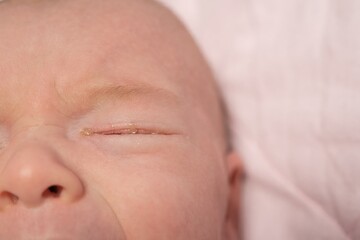 Baby eyes with eye mucus in selective focus. Disease tear ducts tons of newborns close up. Nasolacrimal duct obstruction in baby it is a blockage of the lacrimal drainage system. 