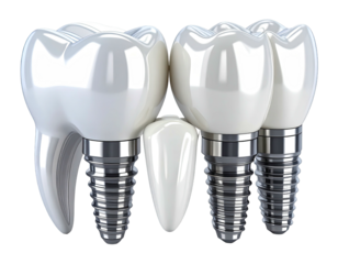 3D model of dental implants