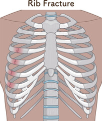 肋骨骨折のイラスト　Broken rib illustration