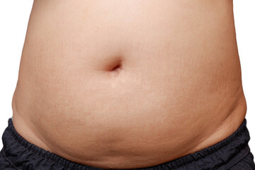 Fat woman, fat belly, obese, water obesity Overweight. Diabetes. Fitness. Abdomen. Adult background, health care concept.