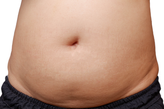 Fat woman, fat belly, obese, water obesity Overweight. Diabetes. Fitness. Abdomen. Adult background, health care concept.