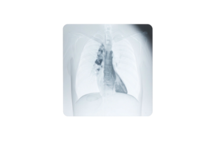 An X-ray of a chest cavity, revealing the lungs and internal structures