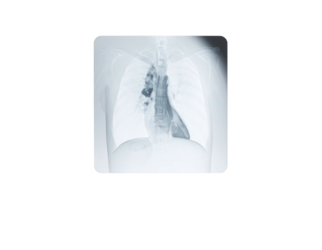 An X-ray of a chest cavity, revealing the lungs and internal structures