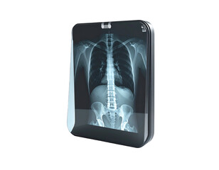 A smartphone displaying a human chest X-ray against a black background