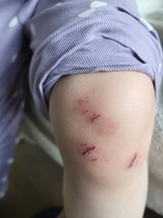 Fototapeta premium Close-up of a child's knee showing multiple small scratches and scabs, illustrating minor skin injury and natural healing process. A child aged 4 years (four years old)