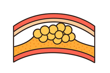 Atherosclerosis plaque buildup in human artery causing arterial narrowing and blockage