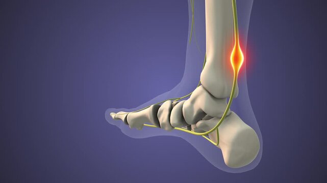 Peripheral Nerve Sheath Tumor in Foot Joint